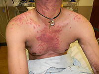 Stevens-Johnson Syndrome